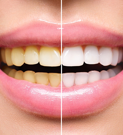 smile before and after teeth whitening