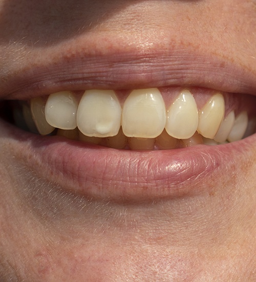 close up of miscolored tooth