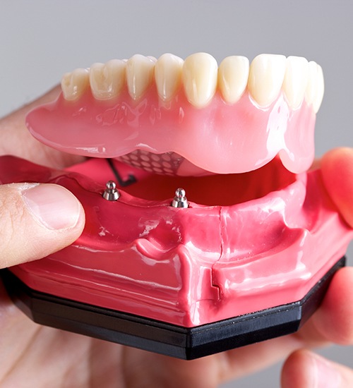 implant supported denture