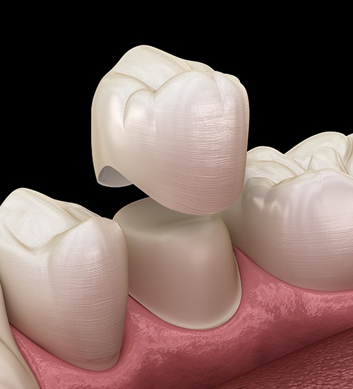 computer illustration of dental crown procedure