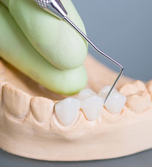 dental bridge