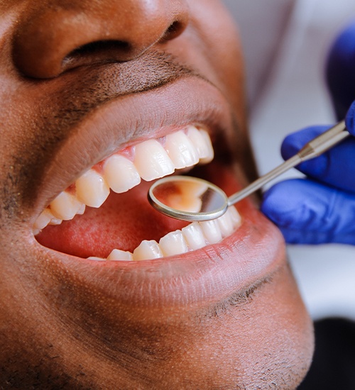 man's smile with tooth-colored fillings